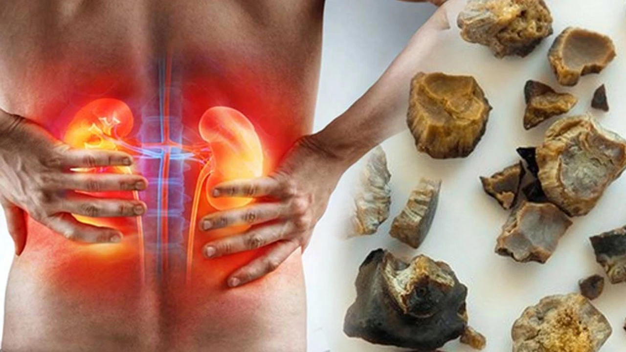 Böbrek Taşı Sorunu Yaşayanların Yorumları: Gerçek Sonuçlar Unravel Forte Softjel Kapsül ile 10 111220191240460375147