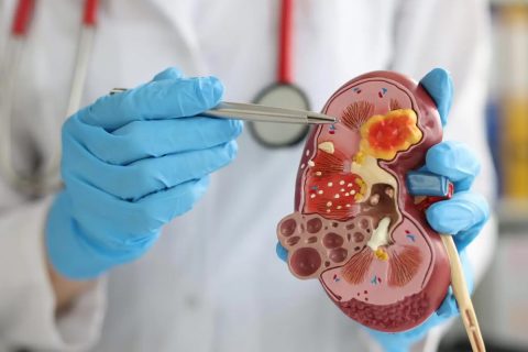 bobrek tasi ameliyati