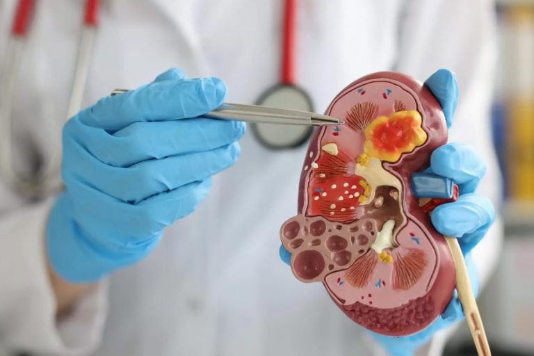 Böbrek Taşlarını Eritmede Etkili Bir Bitkisel Yardımcı: Unravel Forte Softjel Kapsül 4 bobrek tasi ameliyati