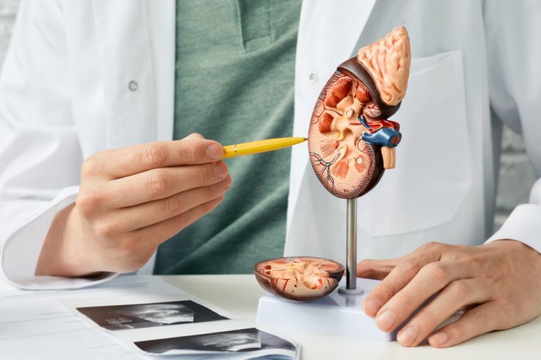 Böbrek Taşı İçin Bitkisel Çözüm mü? Diğer Yöntemler mi? Karşılaştırma ve Unravel Forte Softjel Kapsül'ün Yeri 4 bobrek tasi