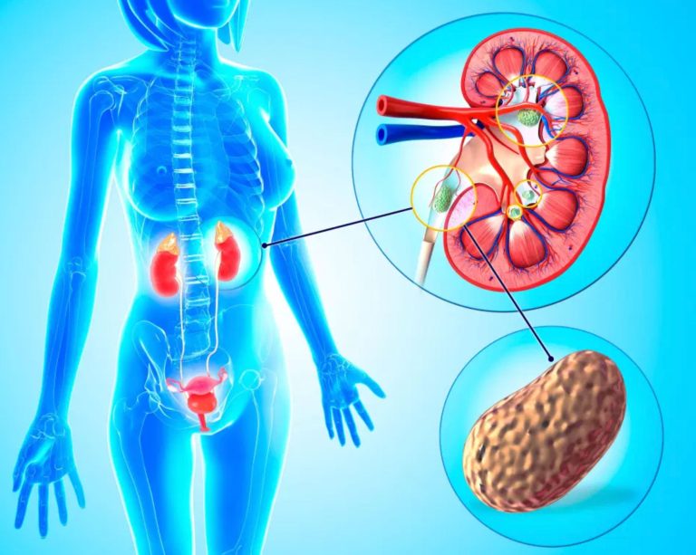 kum dokme bobrek tasi holep uroloji doktoru kadir tepeler tas hastaliklari2